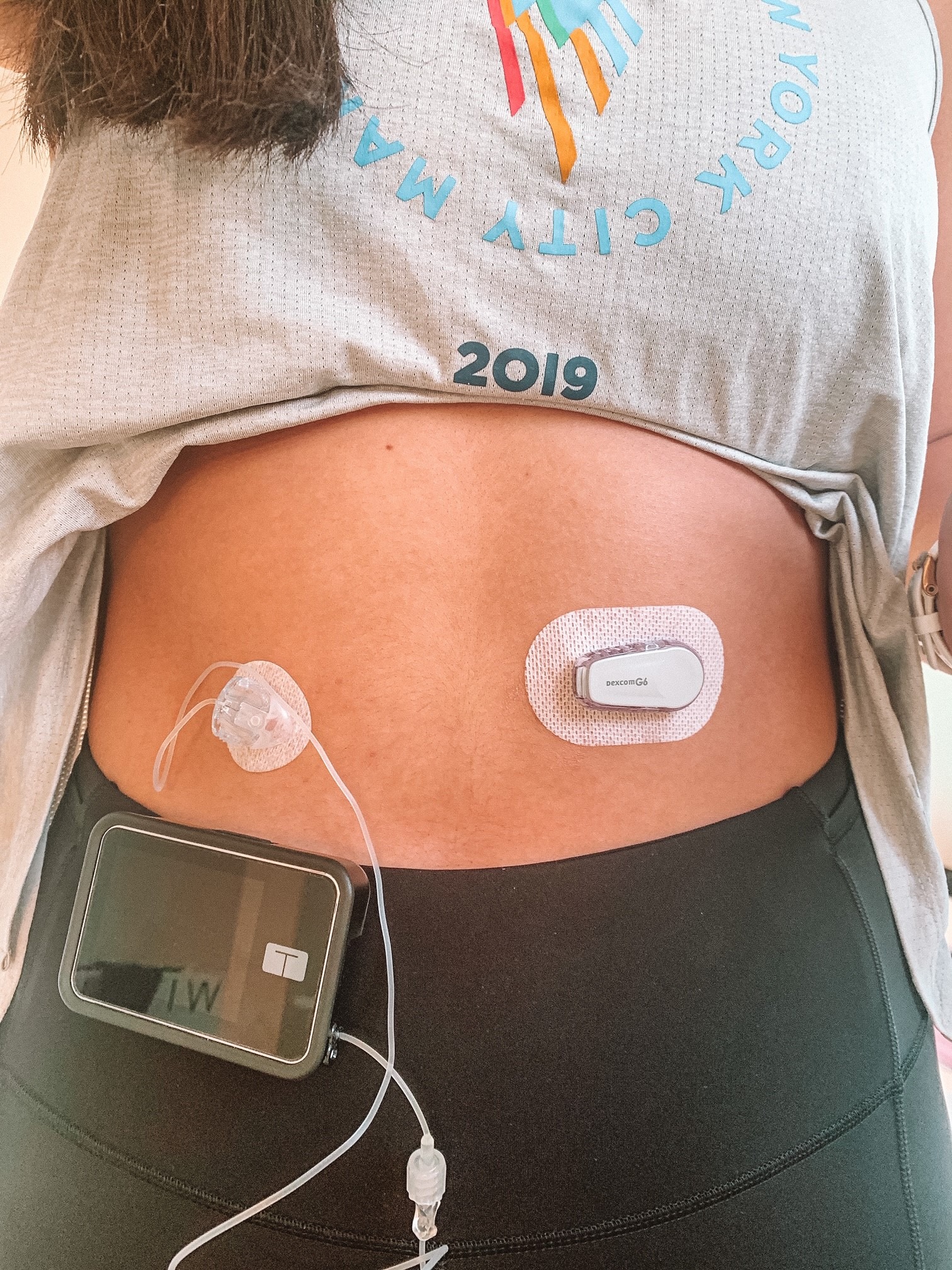 Dexcom G6 Sensor And Insulin Pump My XXX Hot Girl